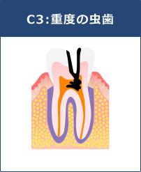 C3:重度の虫歯