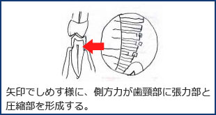 矢印でしめす様に、側方力が歯頸部に張力部と圧縮部を形成する。