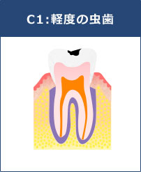 C1:軽度の虫歯