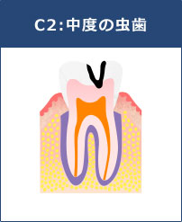 C2:中度の虫歯