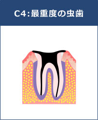 C4:最重度の虫歯